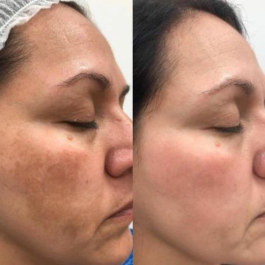 Une peau transformée, masque après masque.