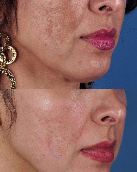 Une peau transformée, masque après masque.