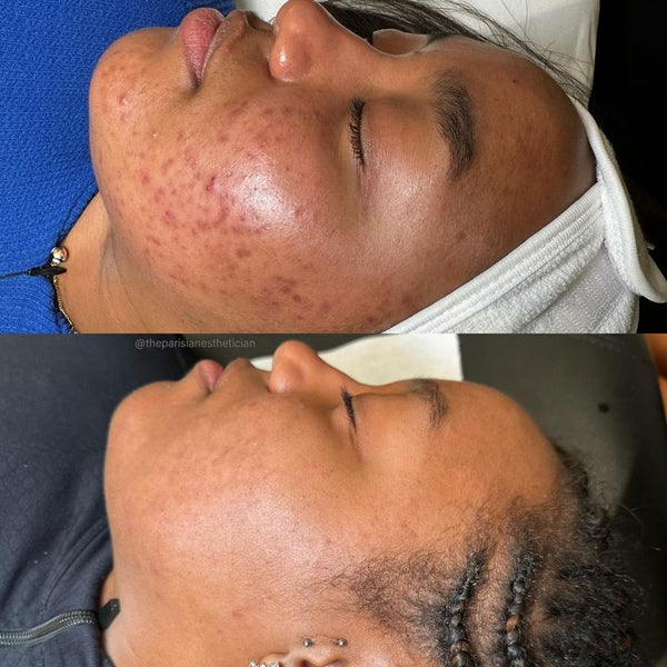 Une peau transformée, masque après masque.