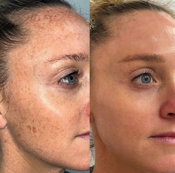 Une peau transformée, masque après masque.