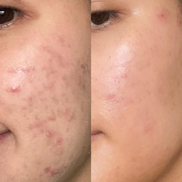 Une peau transformée, masque après masque.