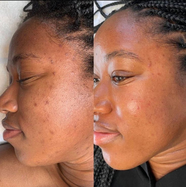 Une peau transformée, masque après masque.