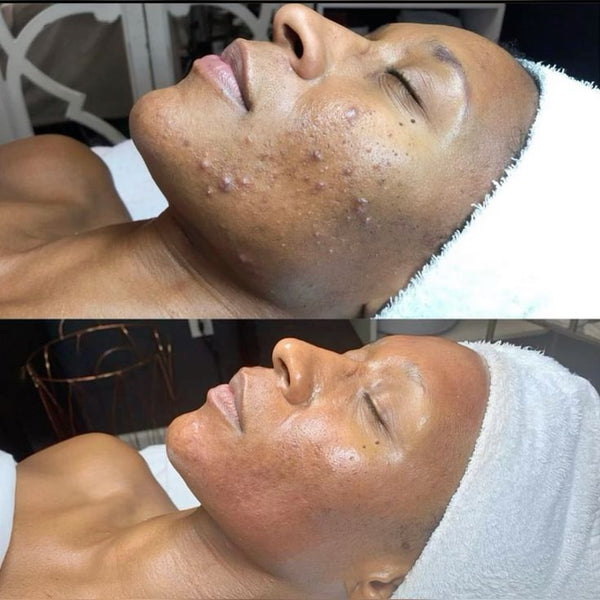 Une peau transformée, masque après masque.